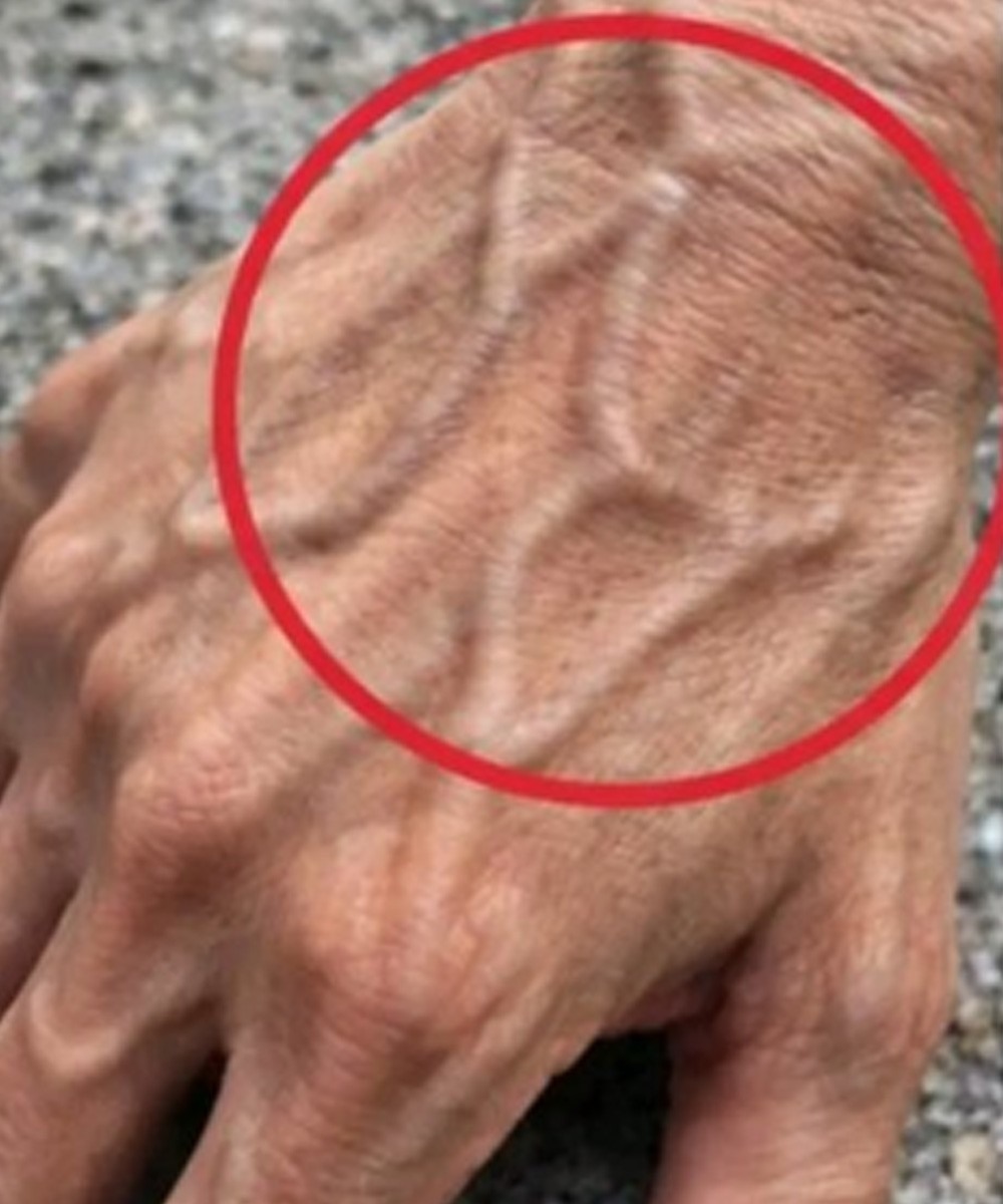 If the veins in your hand are visible, that is a sign of…