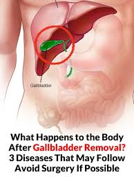 What happens to the body after gallbladder removal? 3 conditions that could occur: avoid surgery if possible!