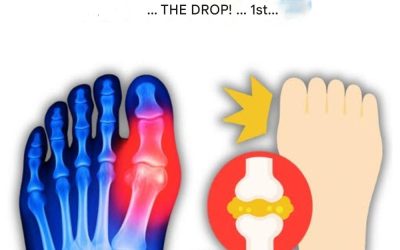 My big toe was on fire… Until I discovered these 5 drinks that naturally eliminate uric acid!